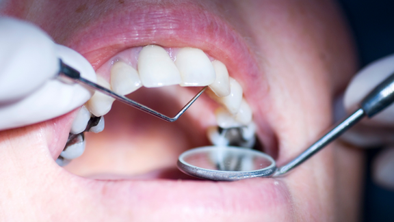 Amalgamsanierung, Zahnarzt Frankfurt, Zahnärztin Dr. Thormeyer, dental island