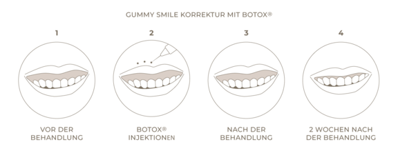 Grafik Gummy Smile, Zahnarzt Frankfurt, Zahnärztin Dr. Thormeyer, dental island