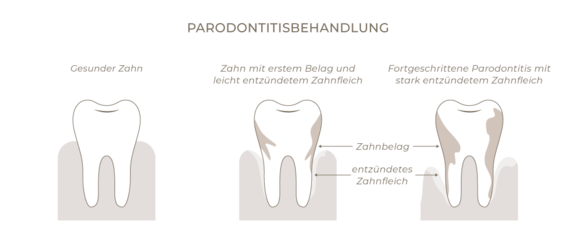 Grafik Parodontitisbehandlung, Zahnarzt Frankfurt, Zahnärztin Dr. Thormeyer, dental island