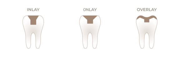 Grafik Inlay & Onlay, Zahnarzt Frankfurt, Zahnärztin Dr. Thormeyer, dental island