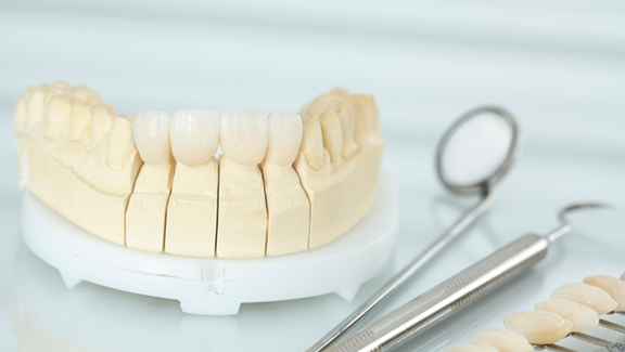 Keramischer Zahnersatz, Zahnarzt Frankfurt, Zahnärztin Dr. Thormeyer, dental island