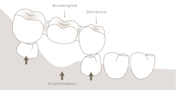 Grafik Zahnbrücke, Zahnarzt Frankfurt, Zahnärztin Dr. Thormeyer, dental island